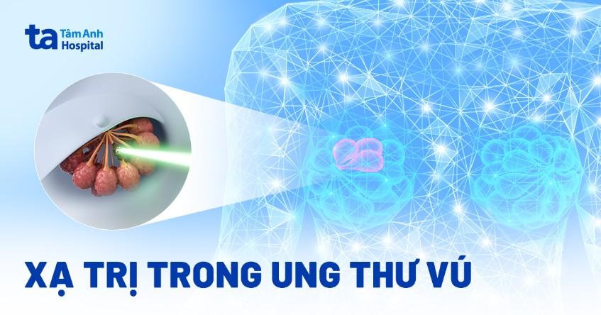 xạ trị ung thư vú