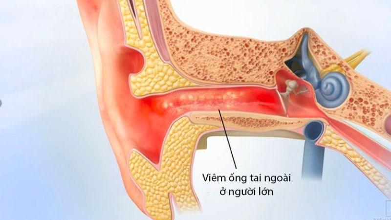 Các phương pháp điều trị bệnh viêm tai giữa