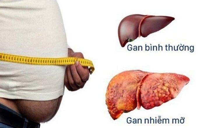 Chuyên gia khuyên người bị gan nhiễm mỡ cần phải đi khám định kỳ từ 3 đến 6 tháng/lần. (Ảnh minh hoạ)