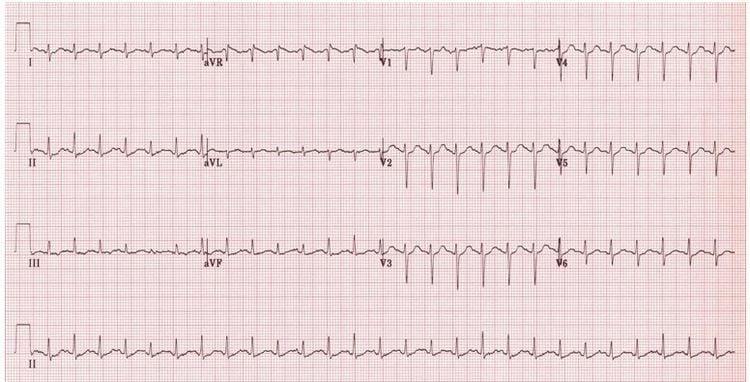 Nhịp xoang nhanh (Nhịp tim 150 bpm. Sóng P ẩn bên trong mỗi sóng T trước)